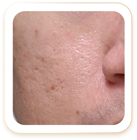 Điều trị sẹo rỗ