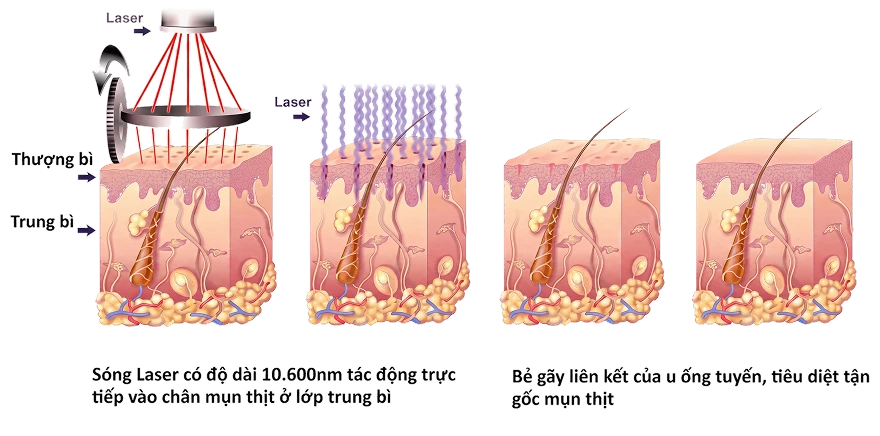 Laser Waves Breakdown