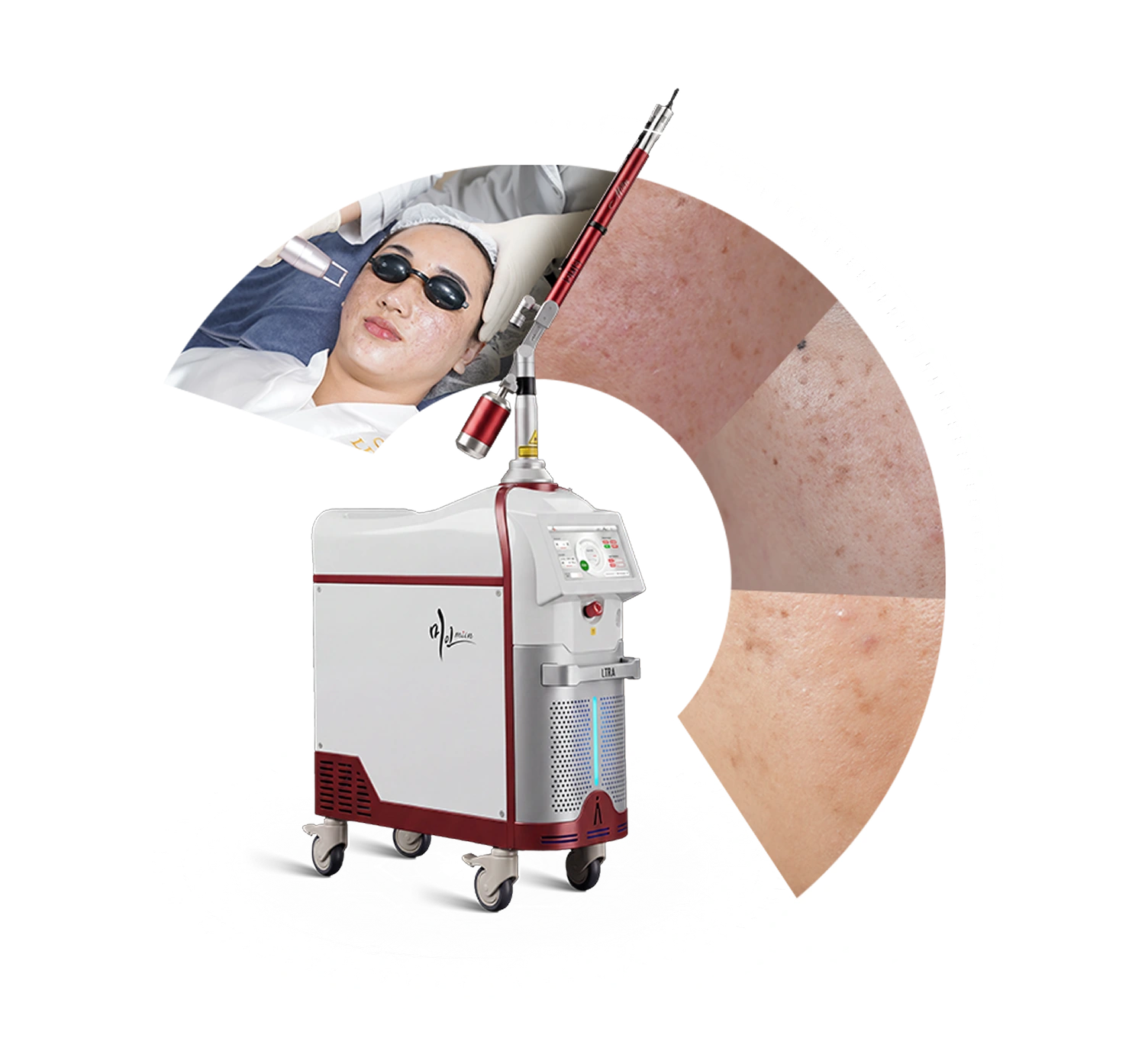 Tác dụng đột phá từ Laser Miin