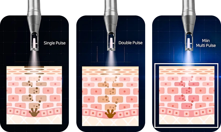 3 chế độ tia Laser