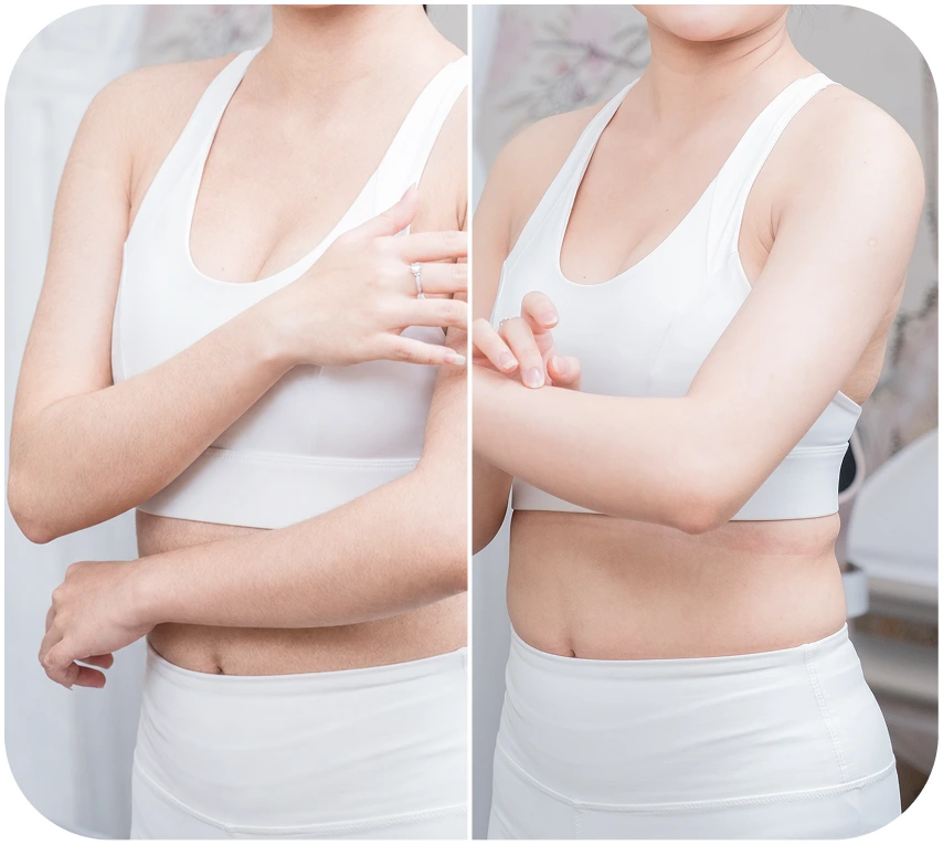 Kết quả triệt lông body khách hàng 1