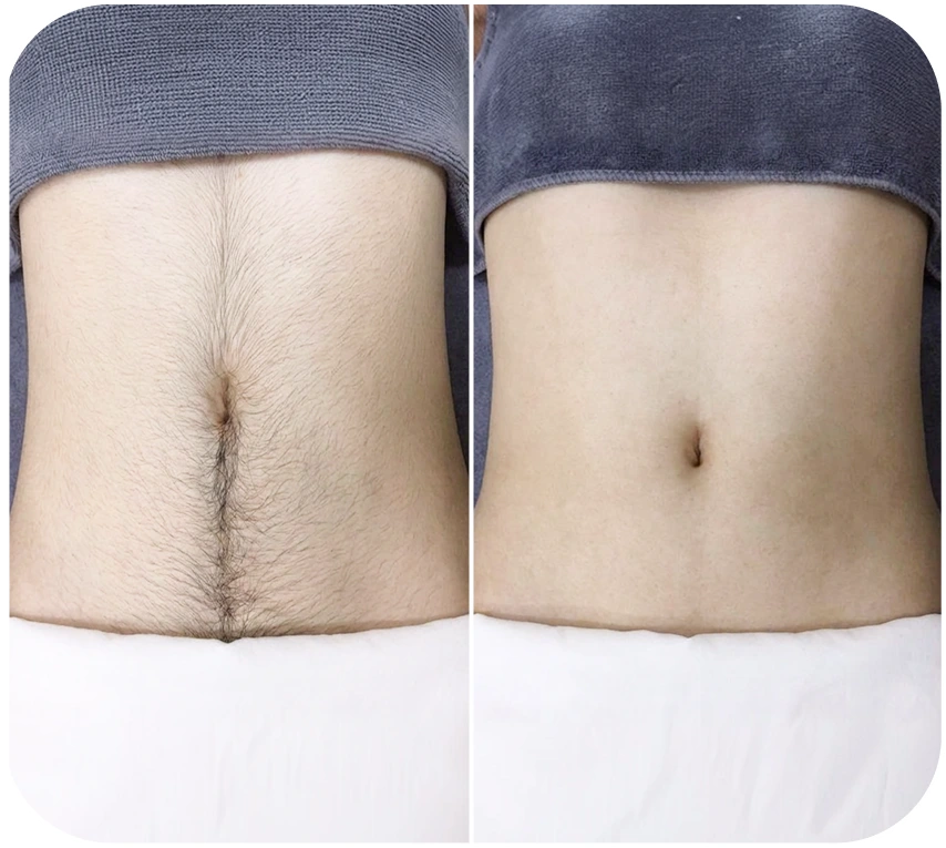 Kết quả triệt lông body khách hàng 2
