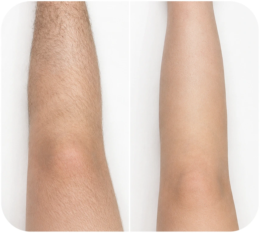 Kết quả triệt lông body khách hàng 3