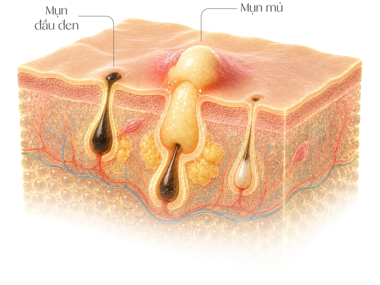 Cấu trúc mụn đầu đen và mụn mủ trong da