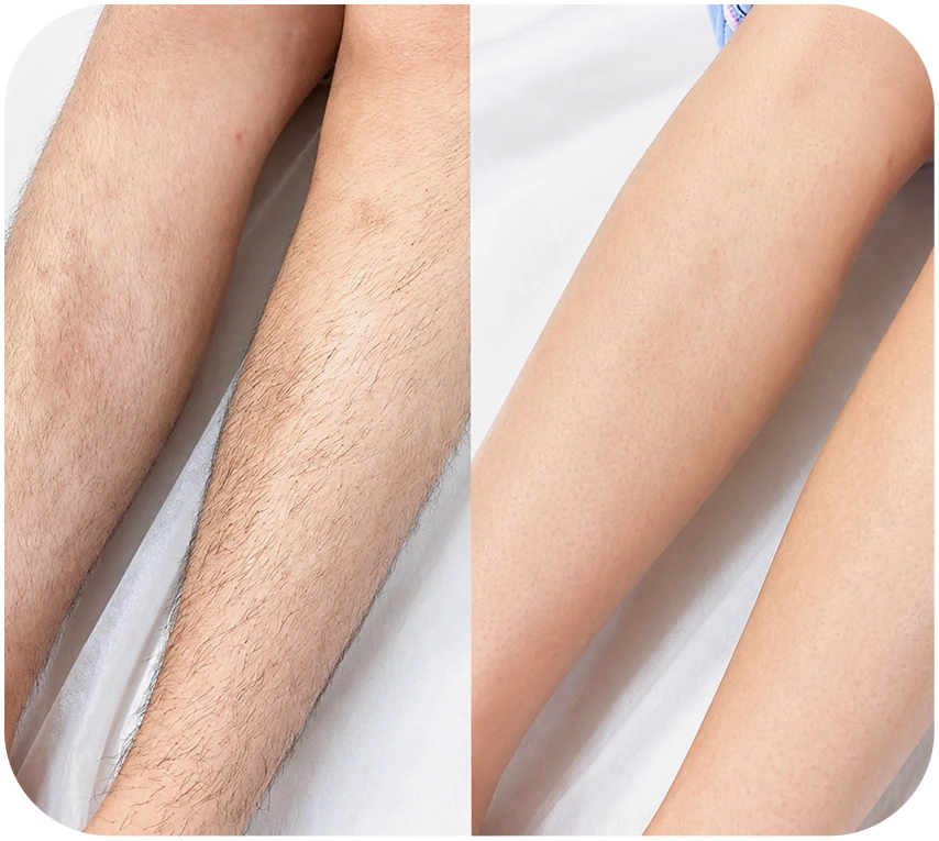 Kết quả triệt lông chân khách hàng 2