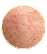 Icon da nhạy cảm dễ kích ứng