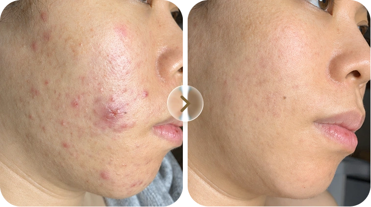 Kết quả trước và sau điều trị mụn case 4
