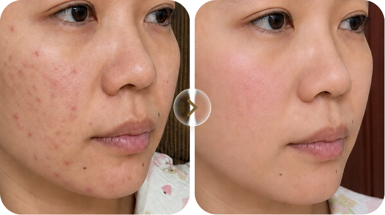 Kết quả trước và sau điều trị mụn case 6