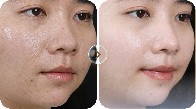 Kết quả trước và sau điều trị mụn case 7