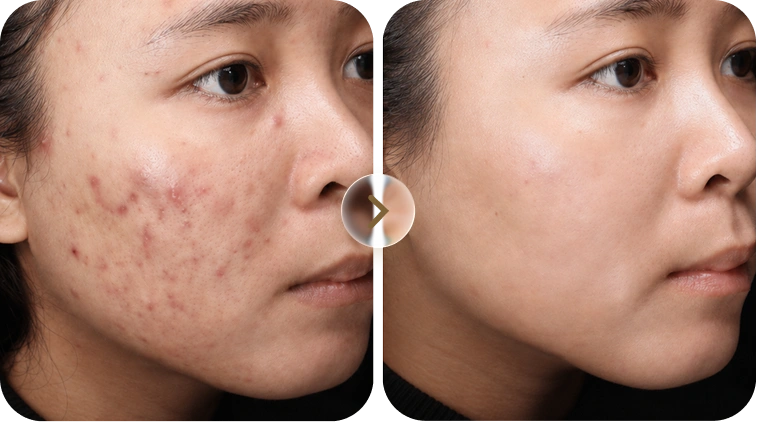 Kết quả trước và sau điều trị mụn case 9
