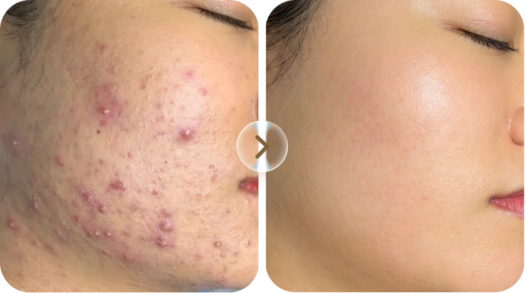 Kết quả trước và sau điều trị mụn của khách hàng Hoàng Lan