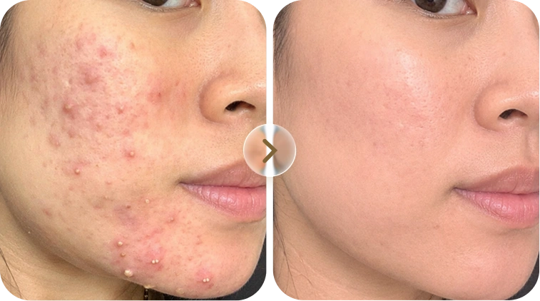 Kết quả trước và sau điều trị mụn của khách hàng Hoàng Mai