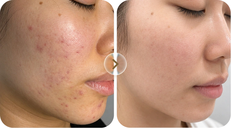 Kết quả trước và sau điều trị mụn của khách hàng Hồng Hạnh