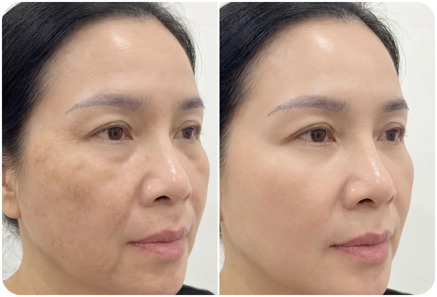 Kết quả trước và sau chăm sóc da của khách hàng Minh Hằng