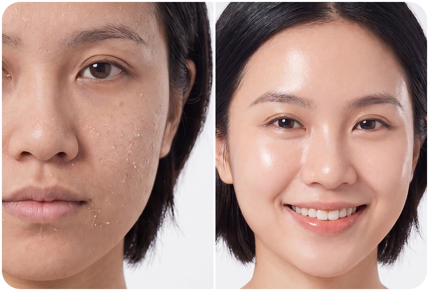 Kết quả trước và sau chăm sóc da của khách hàng Ngọc Nguyễn