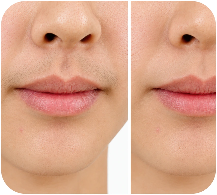 Kết quả triệt lông mép khách hàng 1