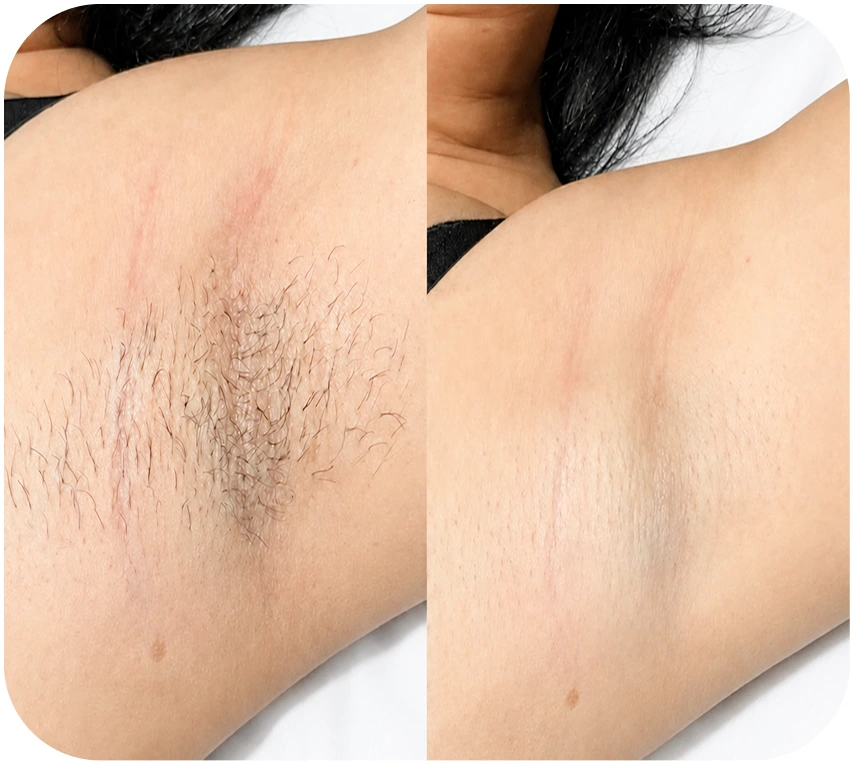Kết quả triệt lông nách khách hàng 1