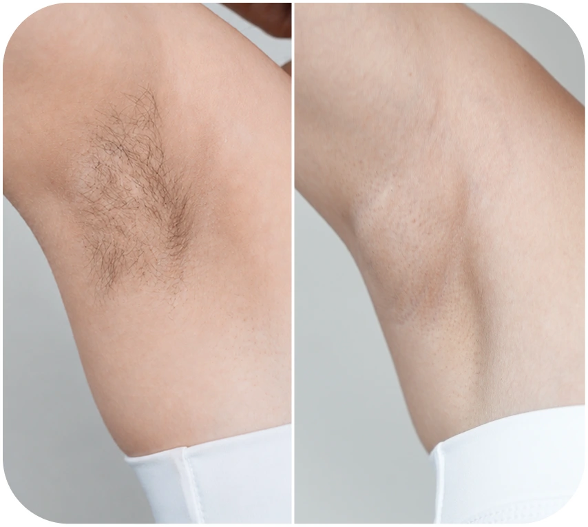 Kết quả triệt lông nách khách hàng 2