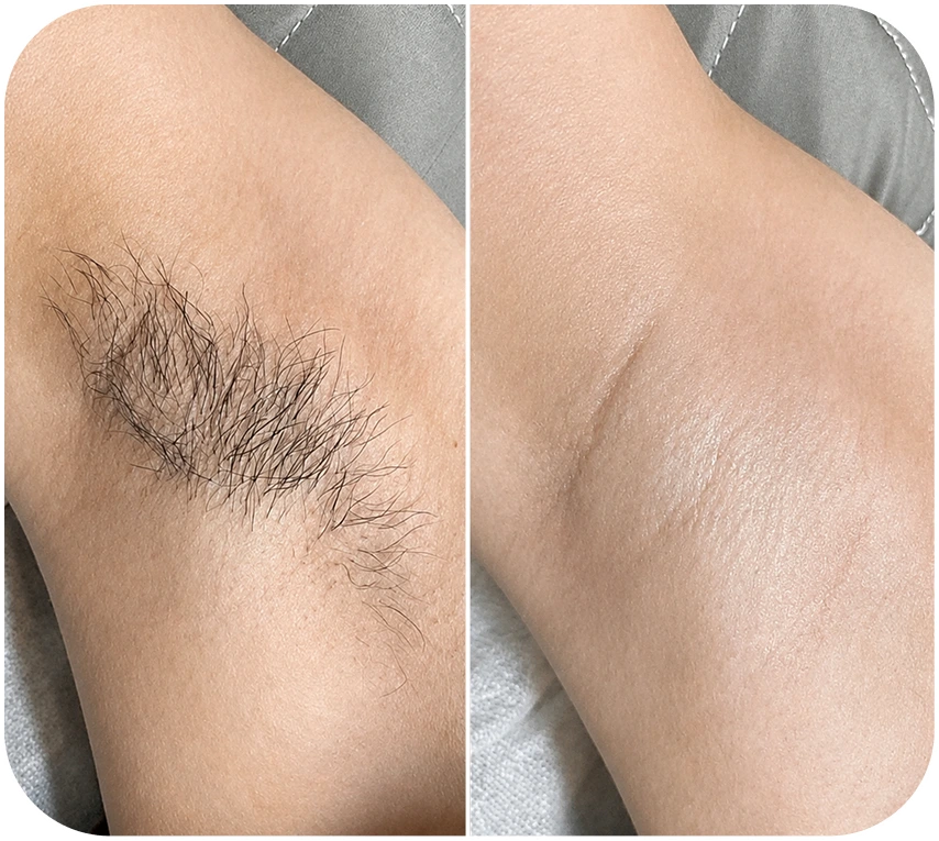 Kết quả triệt lông nách khách hàng 3