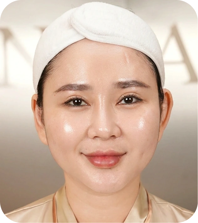 Làn da sau phục hồi của khách hàng Thy Thy