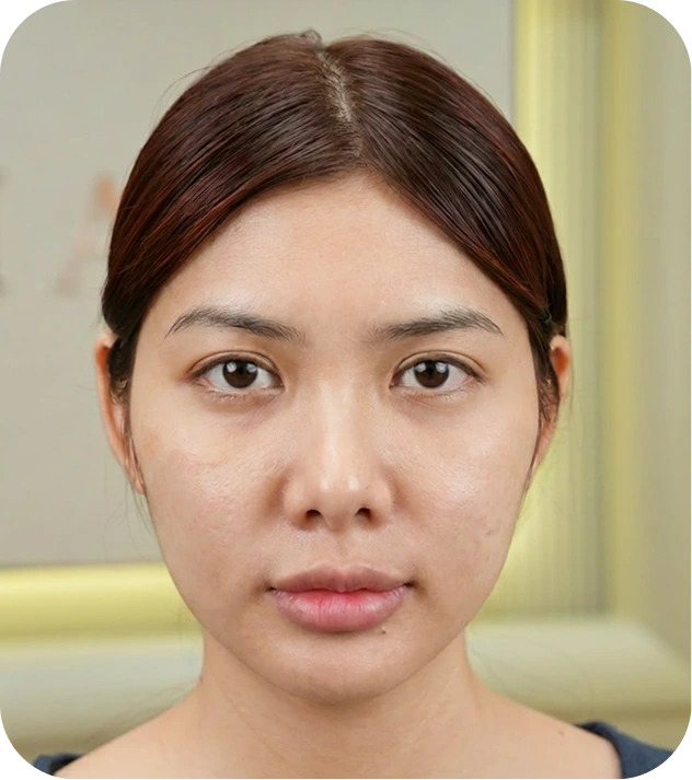 Tình trạng da trước phục hồi của khách hàng Thoại Vy