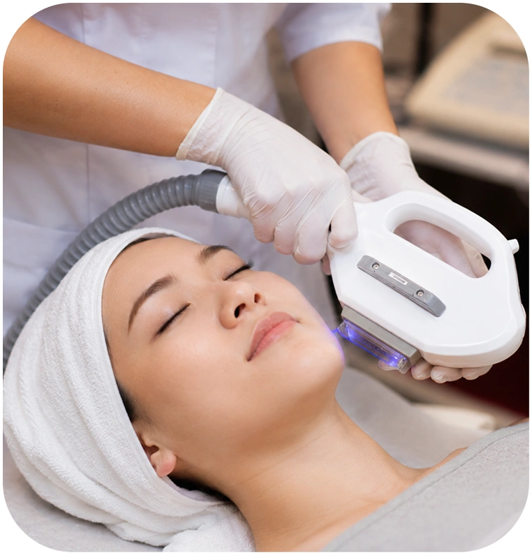 Công nghệ IPL Intense Pulsed Light điều trị mụn