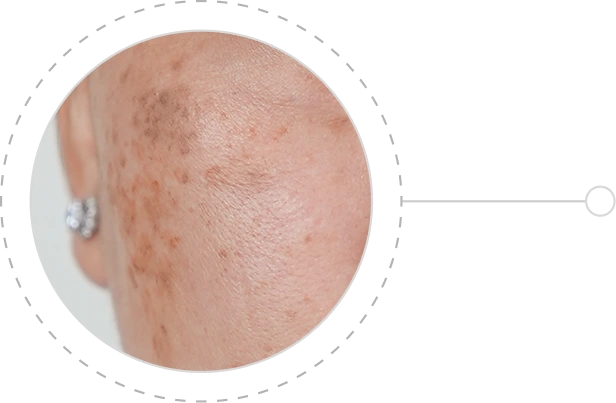 Đốm đồi mồi, nám và sạm da