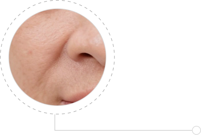 Nếp nhăn và rãnh cười sâu
