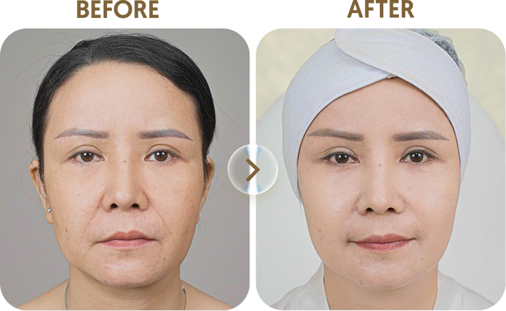 Kết quả trước sau Khách hàng Thảo - 47 tuổi - Căng chỉ sinh học