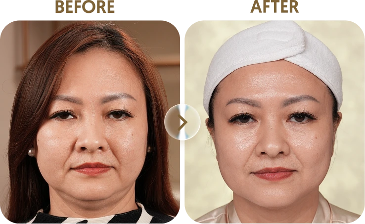 Kết quả trước sau Khách hàng Vy - 50 tuổi - CFU-Elife