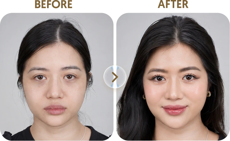 Kết quả trước sau Khách hàng Thiệu - 32 tuổi - Karisma RH Collagen