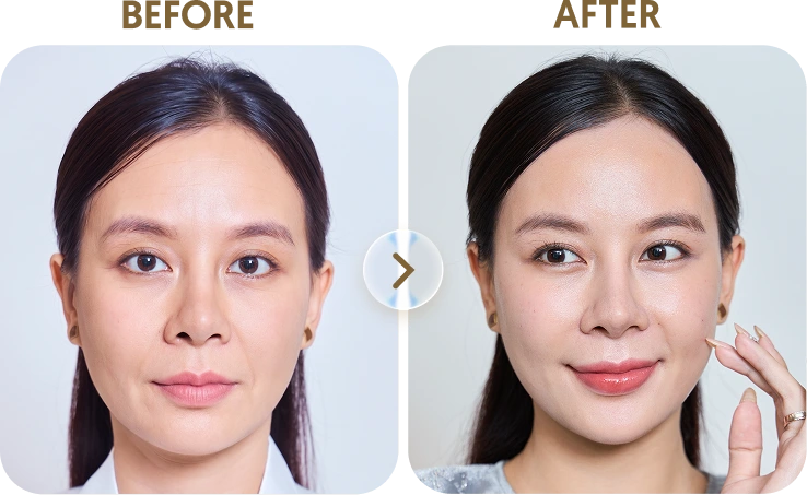 Kết quả trước sau Khách hàng Linh - 30 tuổi - Laser Fractional CO2