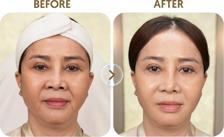 Kết quả trước sau Khách hàng Hạnh - 56 tuổi - Thermage FLX