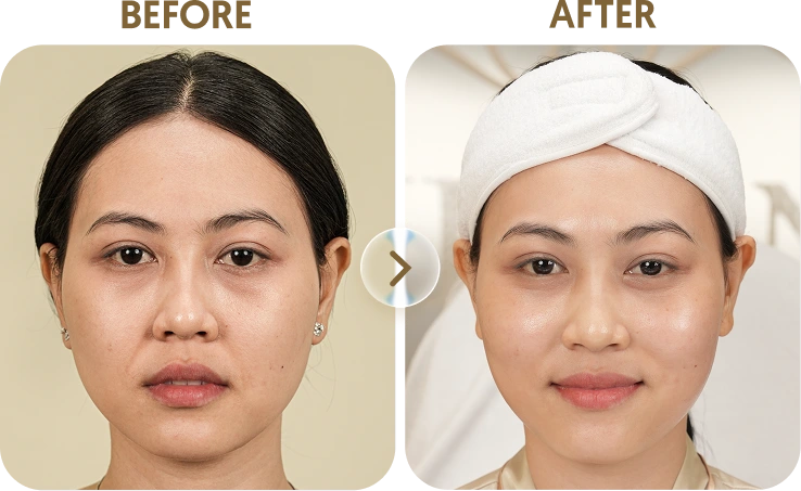 Kết quả trước sau Khách hàng Trang - 45 tuổi - Thermage FLX