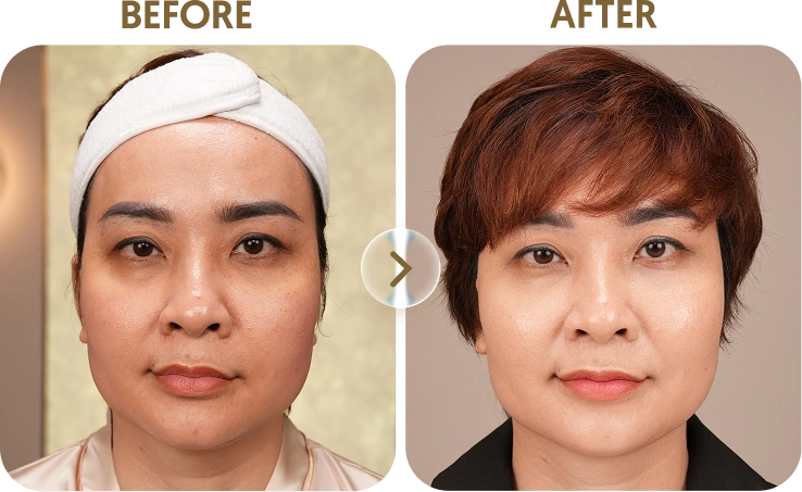 Kết quả trước sau Khách hàng Quỳnh - 30 tuổi - Tiêm Filler