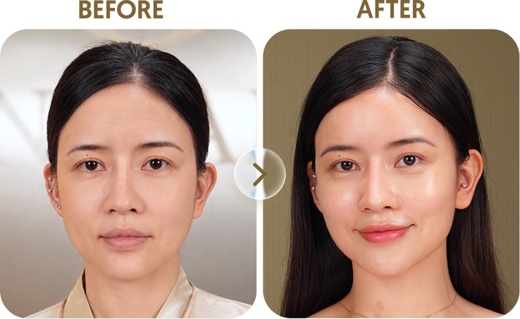 Kết quả trước sau Khách hàng My - 30 tuổi - Tiêm Rejuran
