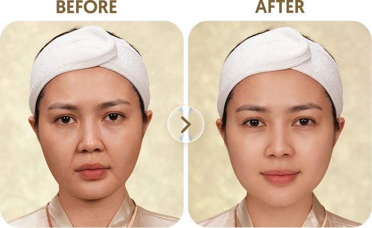 Kết quả trước sau Khách hàng Ngọc - 41 tuổi - Ultherapy Prime