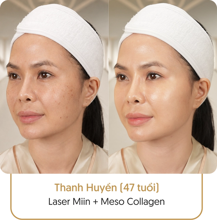 Kết quả điều trị nám của khách hàng tại Linh Anh - Hình 1
