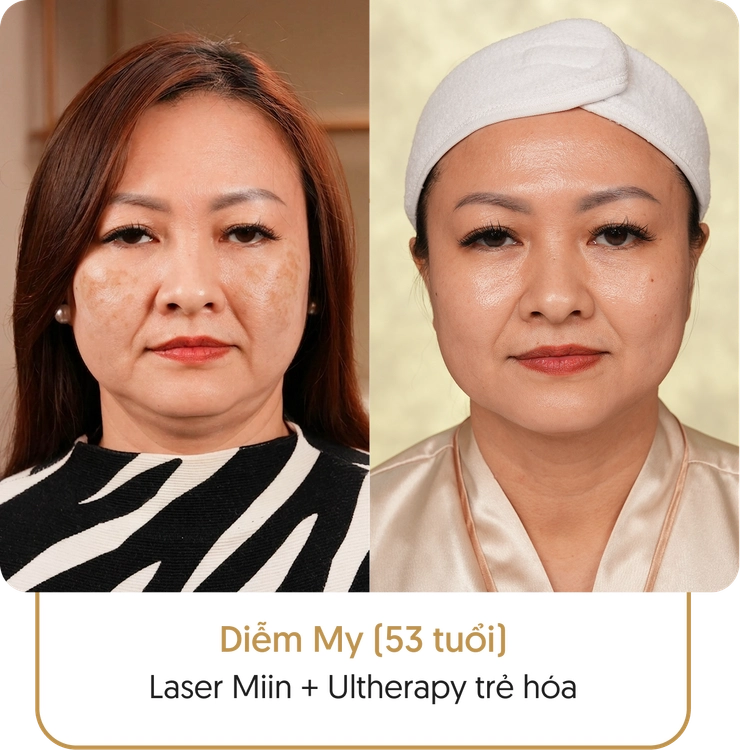 Kết quả điều trị nám của khách hàng tại Linh Anh - Hình 2
