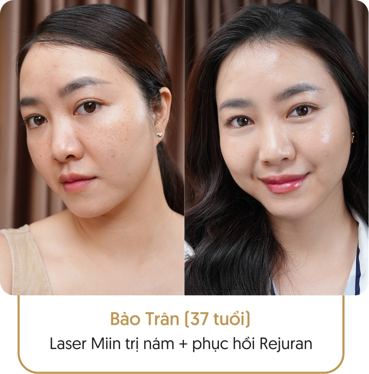 Kết quả điều trị nám của khách hàng tại Linh Anh - Hình 3