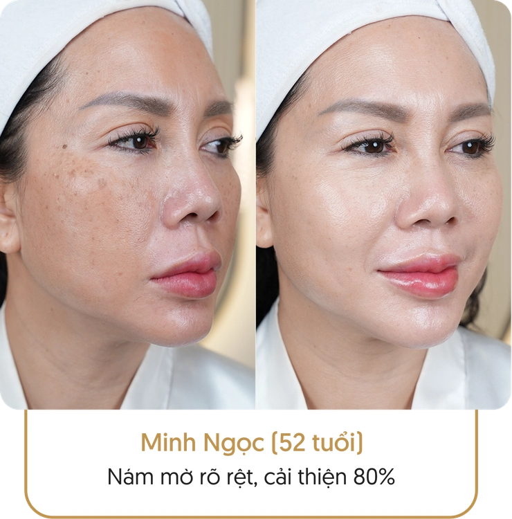 Kết quả điều trị nám của khách hàng tại Linh Anh - Hình 4