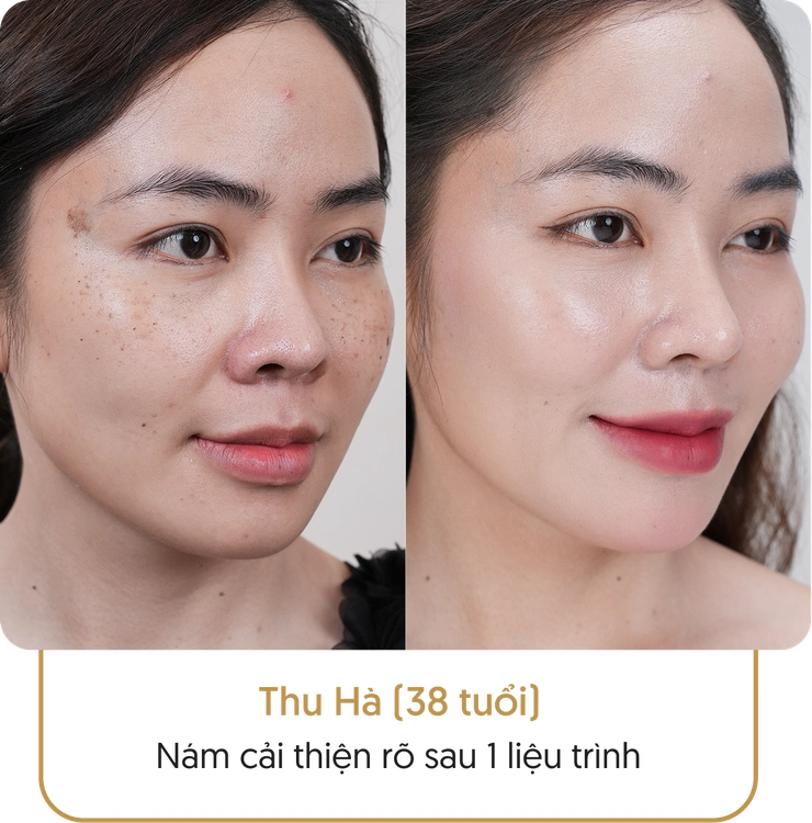 Kết quả điều trị nám của khách hàng tại Linh Anh - Hình 5