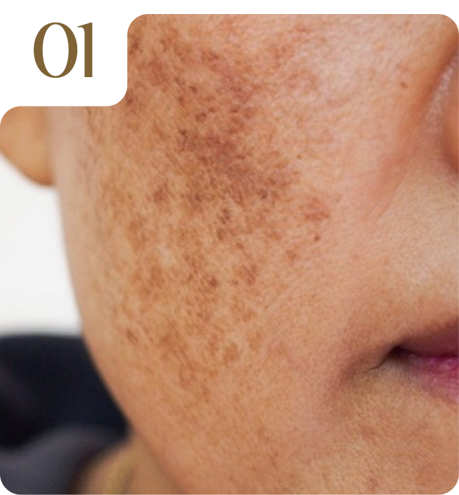 01. Trẻ hóa & chống lão hóa bằng Laser Fotona