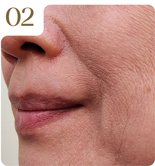02. Điều trị sắc tố chuyên sâu bằng Laser Fotona