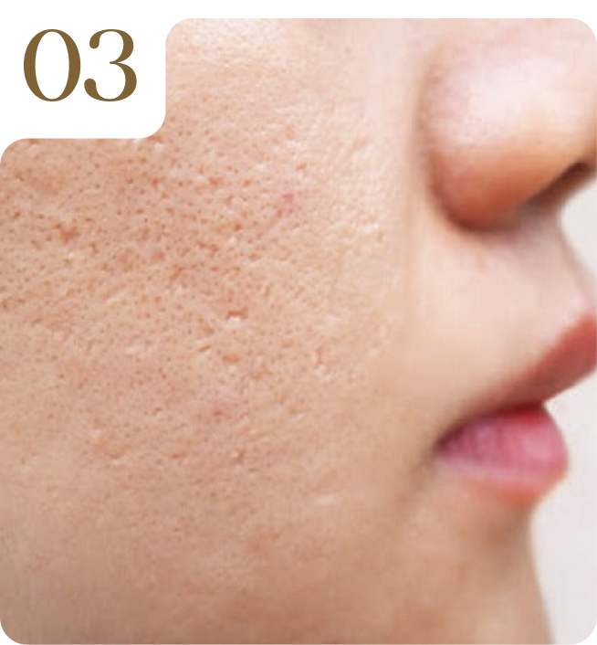 03. Trị sẹo & tái tạo da bằng Laser Fotona