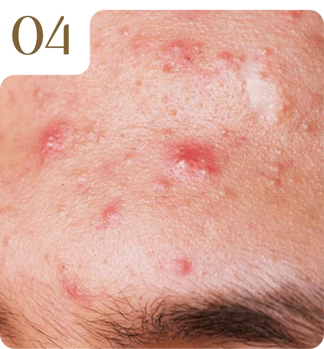 04. Điều trị mụn bằng Laser Fotona