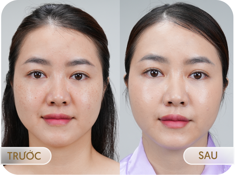 Hình ảnh trước và sau điều trị Laser Fotona của khách hàng Thu Phương (47 tuổi)