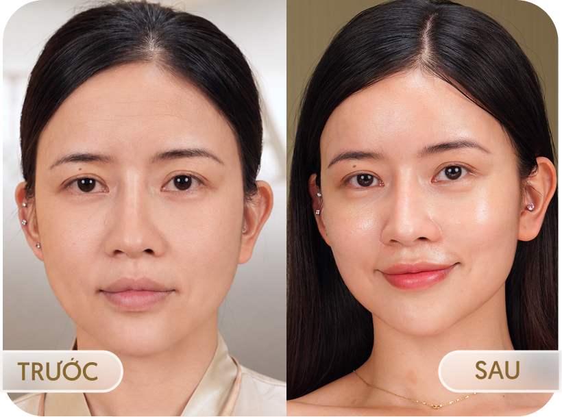 Hình ảnh trước và sau điều trị Laser Fotona của khách hàng Ngọc Lan (29 tuổi)